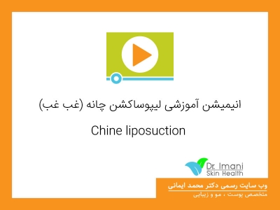 انیمیشن آموزشی ليپوساكشن چانه (غب غب) Chine liposuction
