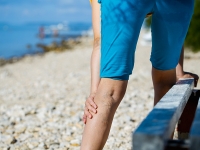 درمان رگ های واریسی ران و ساق پا