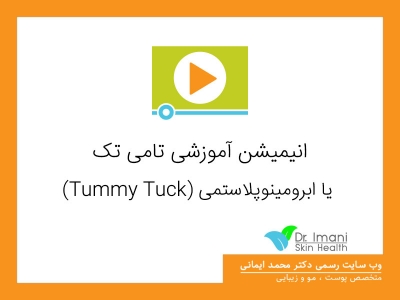 انیمیشن آموزشی تامی تک یا ابرومینوپلاستمی (Tummy Tuck)