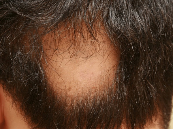 ریزش سكه ای مو یا آلوپسی آره آتا (Alopecia Areata)